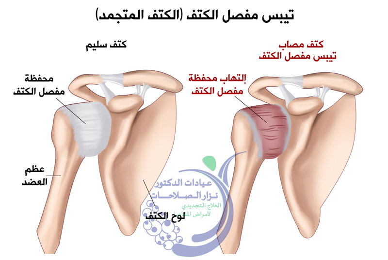 الم مفصل الكتف - كيف اتخلص من الم الكتف و المفاصل 470 6