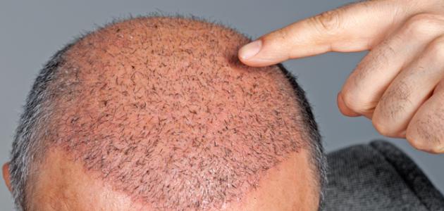 ما بعد زراعة الشعر , اللى بيحصل بعد هذه العمليه الراءعه