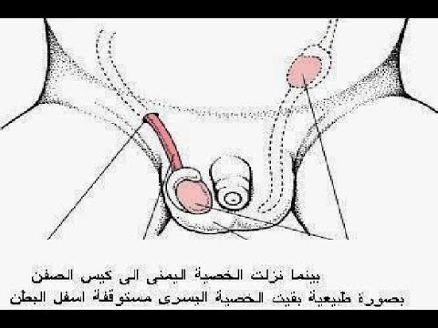 علاج الخصية المعلقة - طرق طبيه للتخلص من عدم الانجاب 995 1