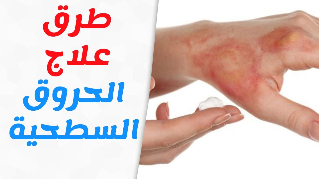 علاج الحروق في المنزل ، طرق بسيطة للتخلص من اثار الحروق 2210