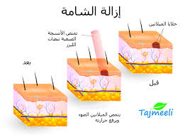 ازالة الشامة بالليزر - سعر ازالة الشامة تجميليلا 509 4 1