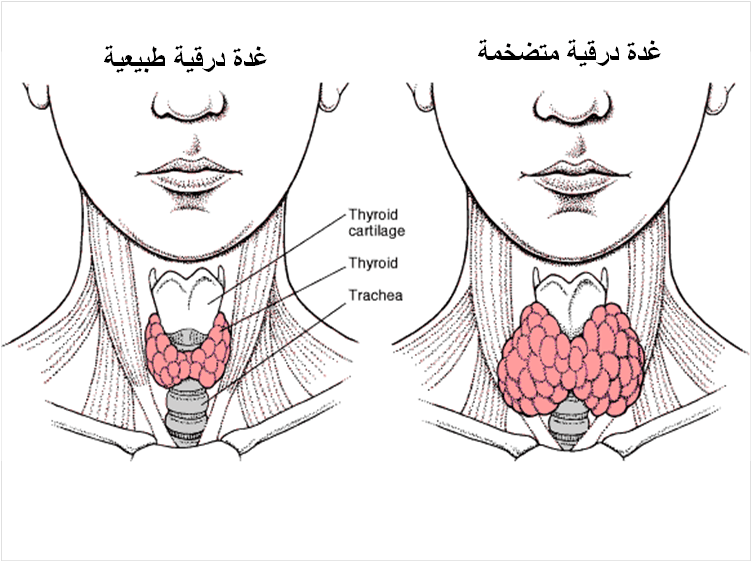 علاج خمول الغدة الدرقية بالاعشاب - الغده الدرقيه وعلاجها بالاعشاب 2757