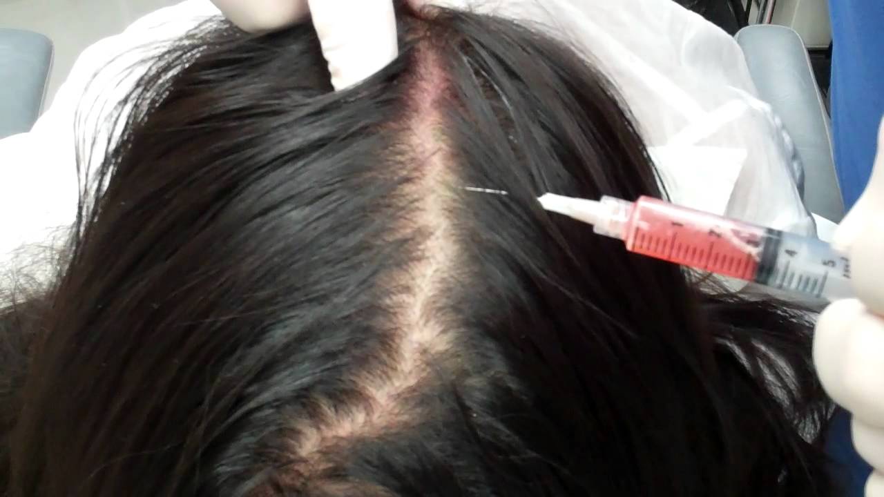 اكاديمية زراعة الشعر , اهم الطرق للتخلص من صلع الشعر