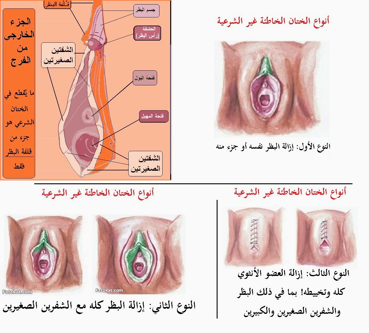 حكم ختان البنات , هل يكون حرام