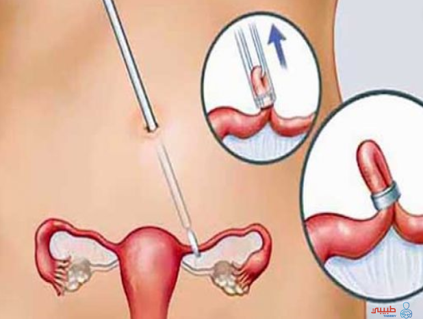 عملية ربط عنق الرحم اسباب الاجراء النتائج والاعراض الجانبية - اسباب عملية الرحم 59657