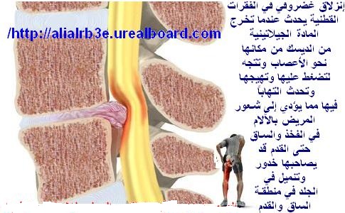 علاج الغضروف بالطب النبوى , كيف اتخلص من الغضروف في اسرع وقت