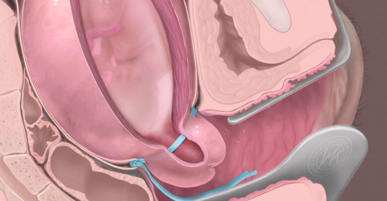 عملية ربط عنق الرحم اسباب الاجراء النتائج والاعراض الجانبية , اسباب عملية الرحم