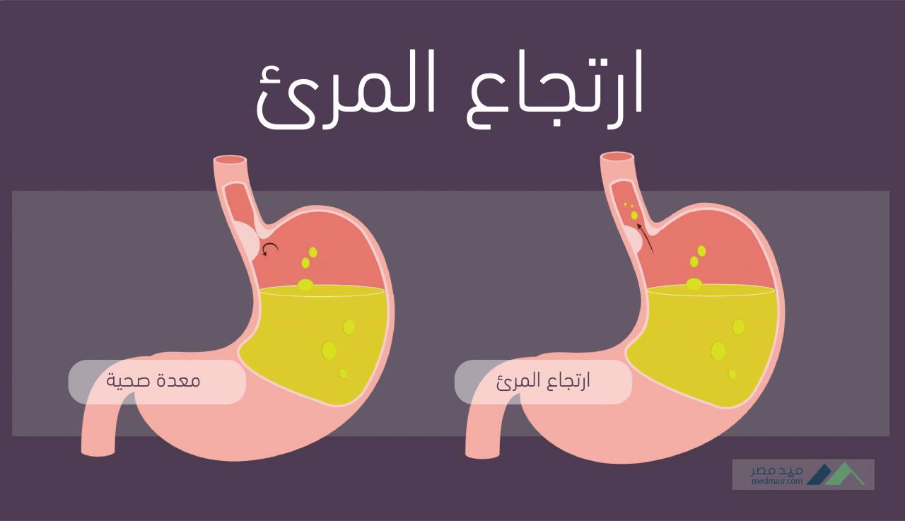 اعراض ارتجاع المريء , الأعراض الكاملة لإرتجاع المريء