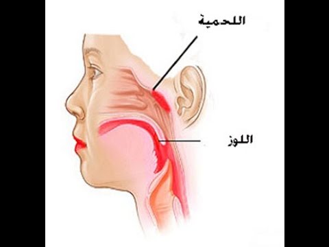 لحمية الانف عند الاطفال - عملية اللحمية مشكلة قصوي 1466 1