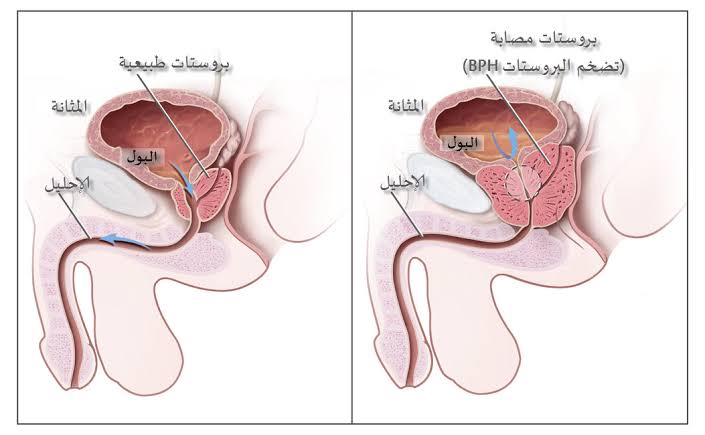 حجم البروستاتا 50 , علاجات تضخم البروستاتا